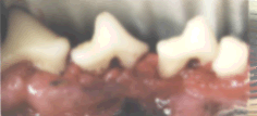 Gingivitis Teeth