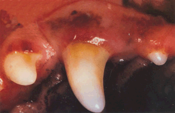 periodontal disease